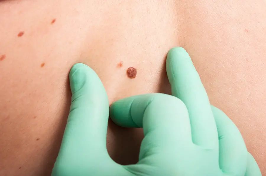 types of skin biopsy for mole removal